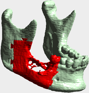 lower jaw with cancer