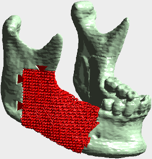 lower jaw with custom implant